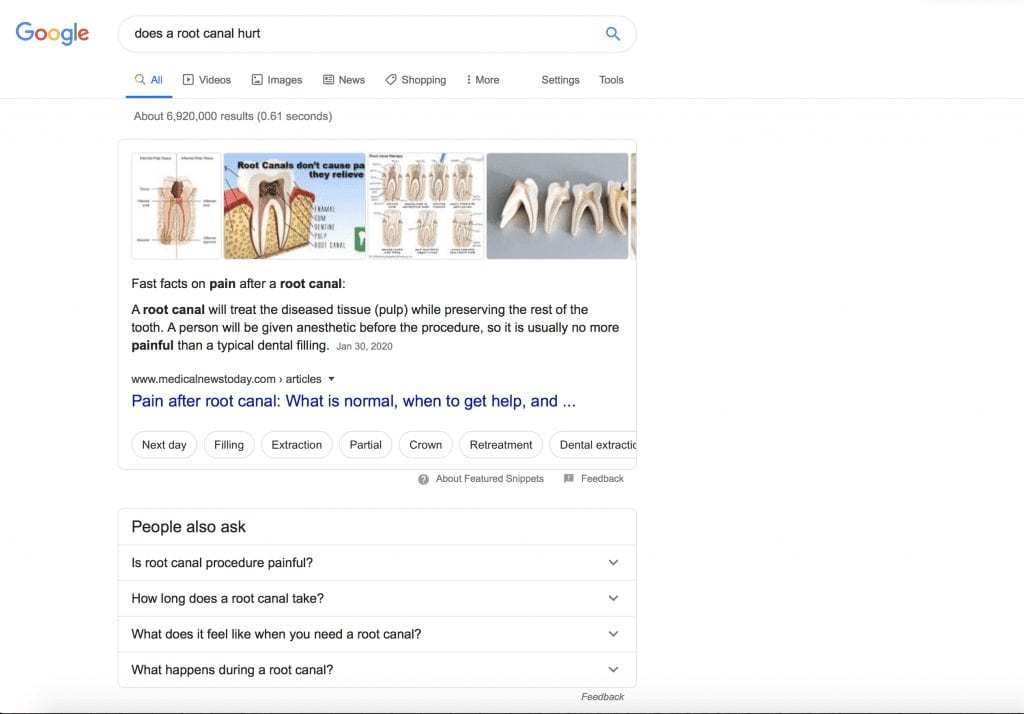 SERP for the query does a root canal hurt
